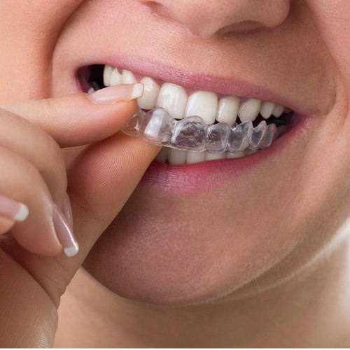 how invisalign works 2