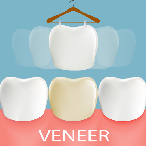 benefits of veneers