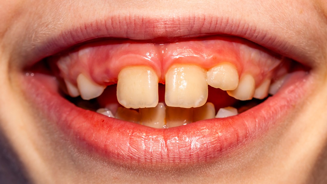 Close Gaps in Front Teeth with Veneers or Braces? Mt Lawley Cosmetic Dentist