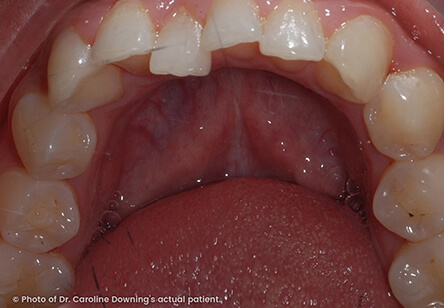 Invisalign – Lower View