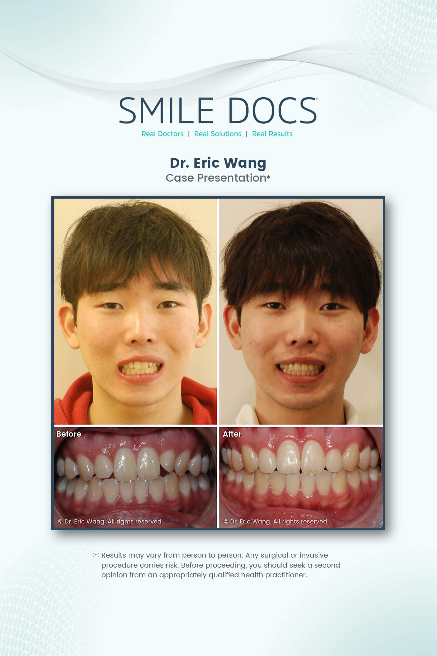 Kids Orthodontics – Damon Clear