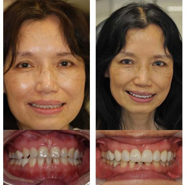 lady with nice smile makeover with veneers