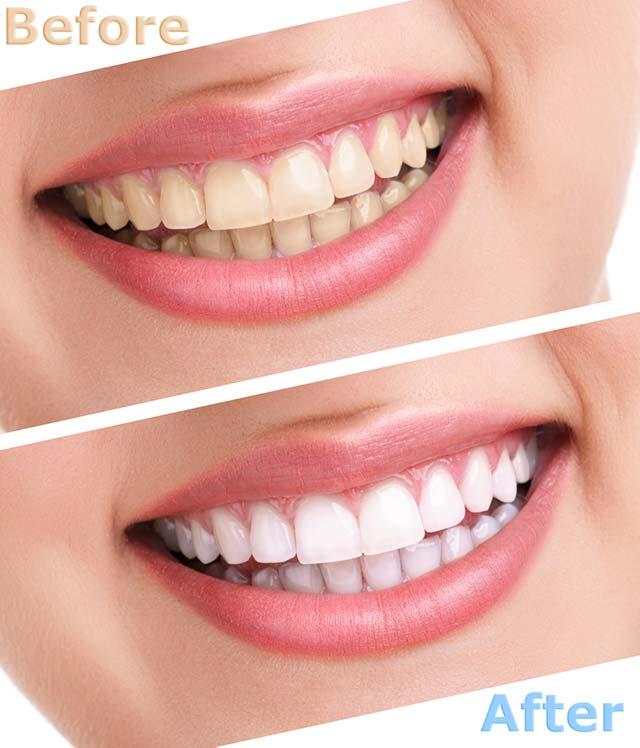 bleached teeth results by Mosman Pk dentist