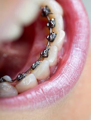braces attached behind the teeth