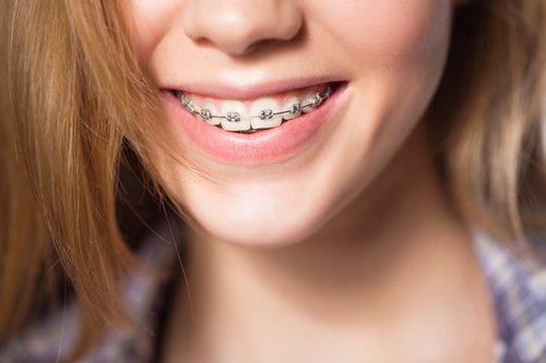 orthodontics on child teeth
