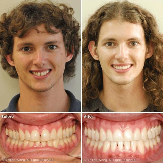 Before after Damon braces