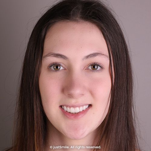 Too Much Gum Showing When Smiling