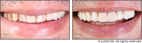 Porcelain Veneers