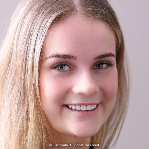 Uneven Stained Teeth Transformation with Porcelain Veneers