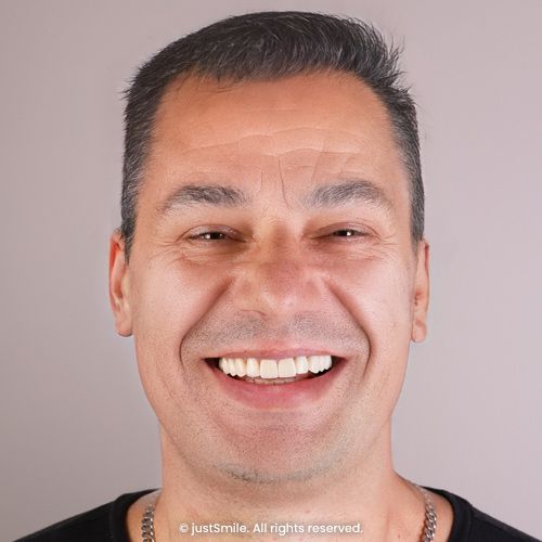 Chipped and Uneven Teeth Solved with Porcelain Veneers