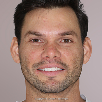 Miss-aligned and Overlapped Teeth