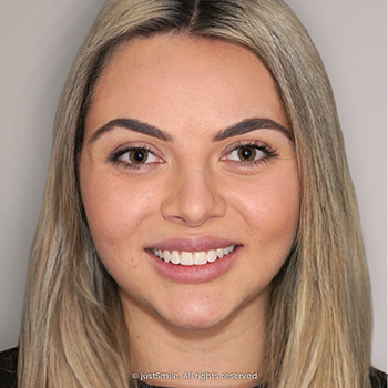 Narrow Smile with Overlapped Teeth