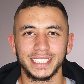 Extreme Miss-alignment of Teeth