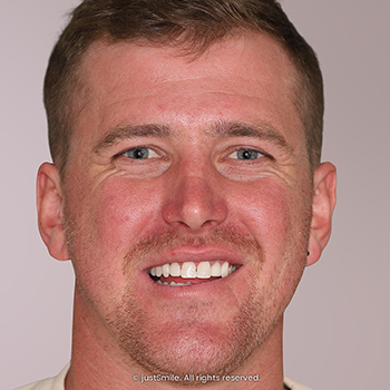 Miss-alignment and Tooth Shape