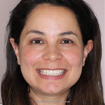 Gaps Between Front Teeth