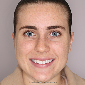 Narrow smile with overlapped top front teeth