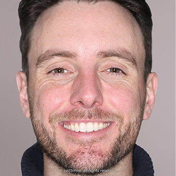 Open bite after orthodontic treatment