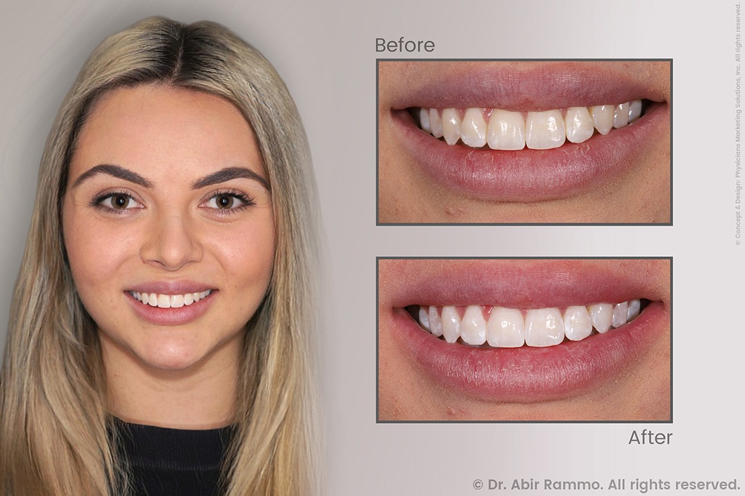Narrow Smile with Overlapped Teeth - Family and Cosmetic Services in ...