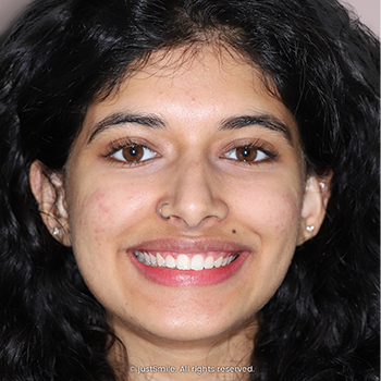 miss-aligned top teeth and short central front tooth