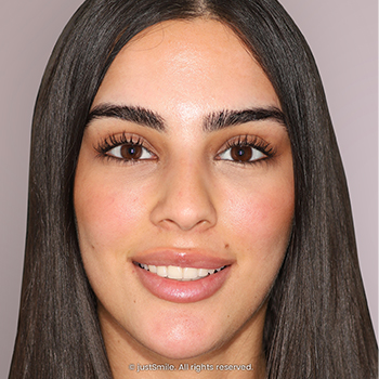 Miss-Aligned top front teeth, Jessica was very self aware and avoiding showing teeth when smiling.