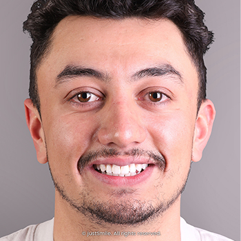 Front Teeth Position