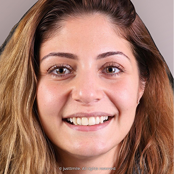 Miss-aligned Protruding Teeth