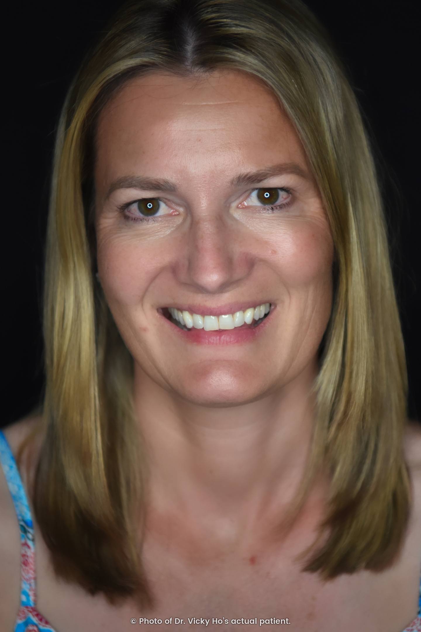 Invisalign Clear Aligners for Crowded, Crooked Teeth
