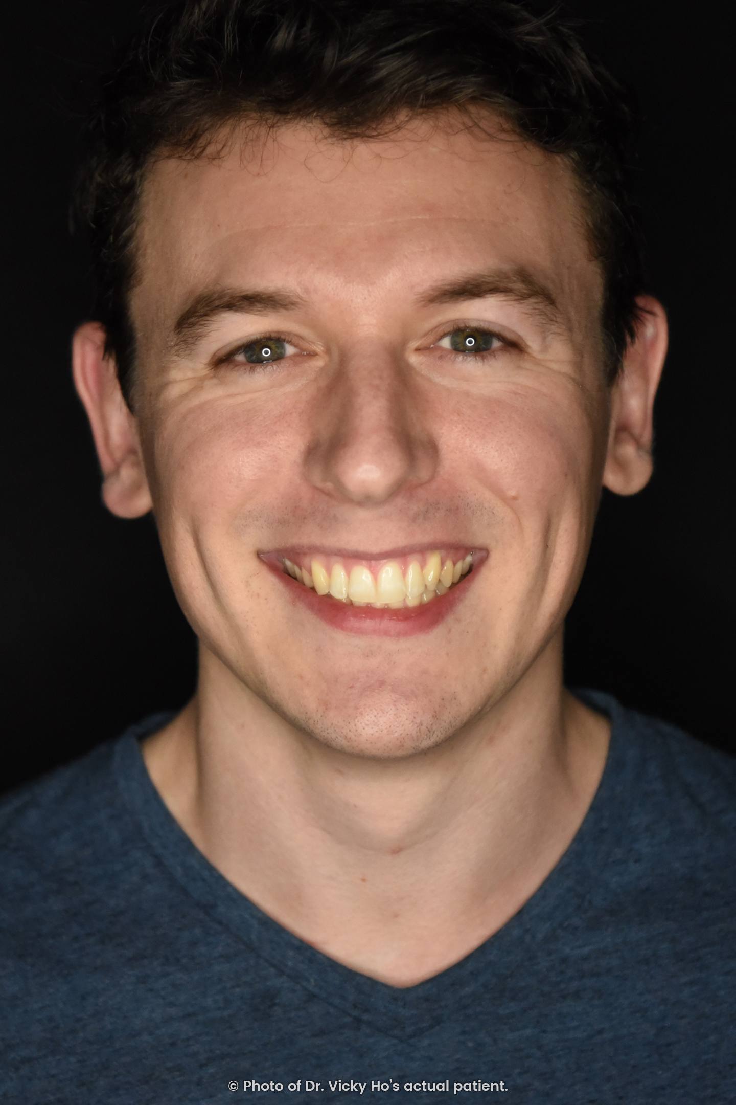 Protruding Teeth Treated with Invisalign