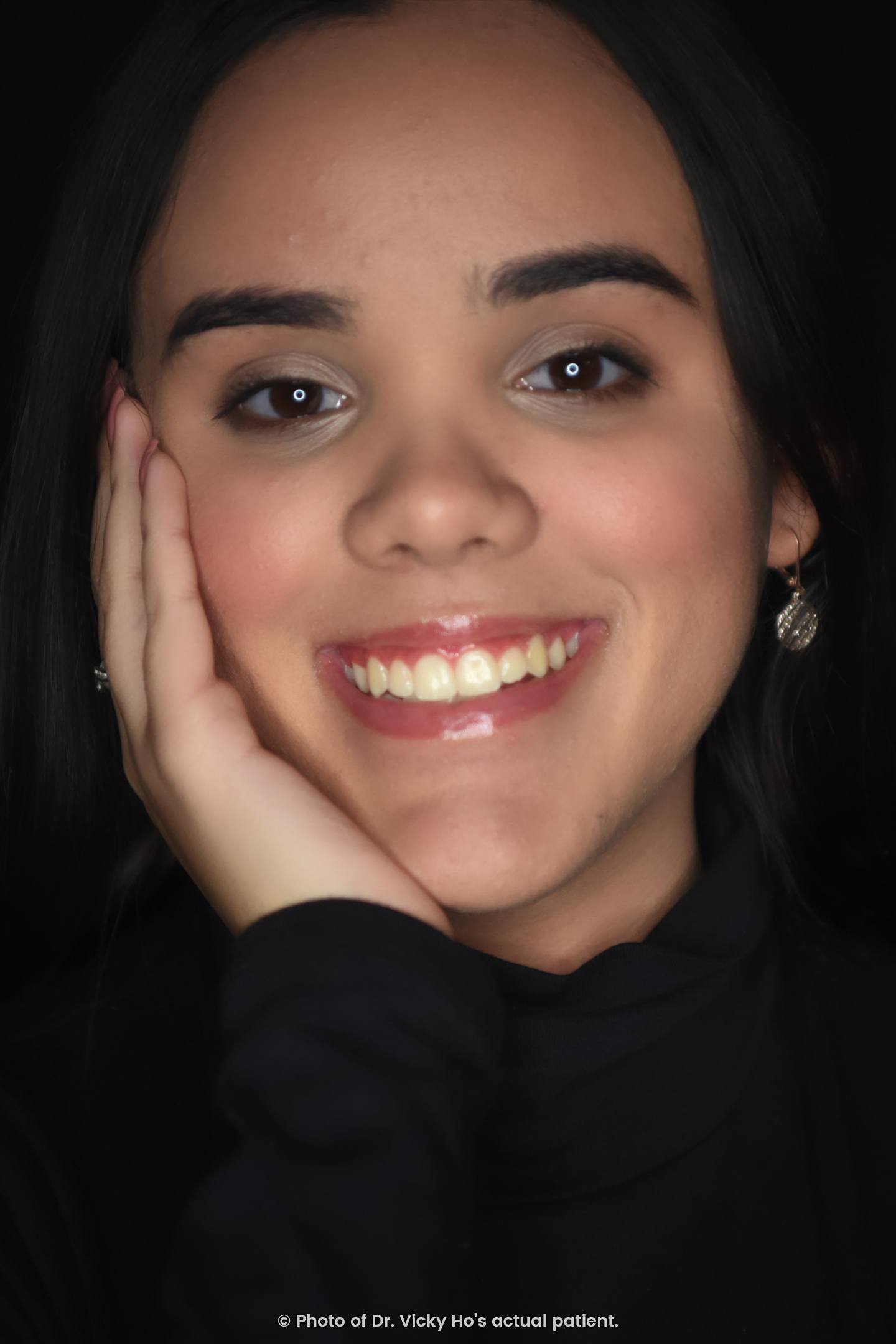 Invisalign Clear Aligners for Crowded, Crooked Teeth