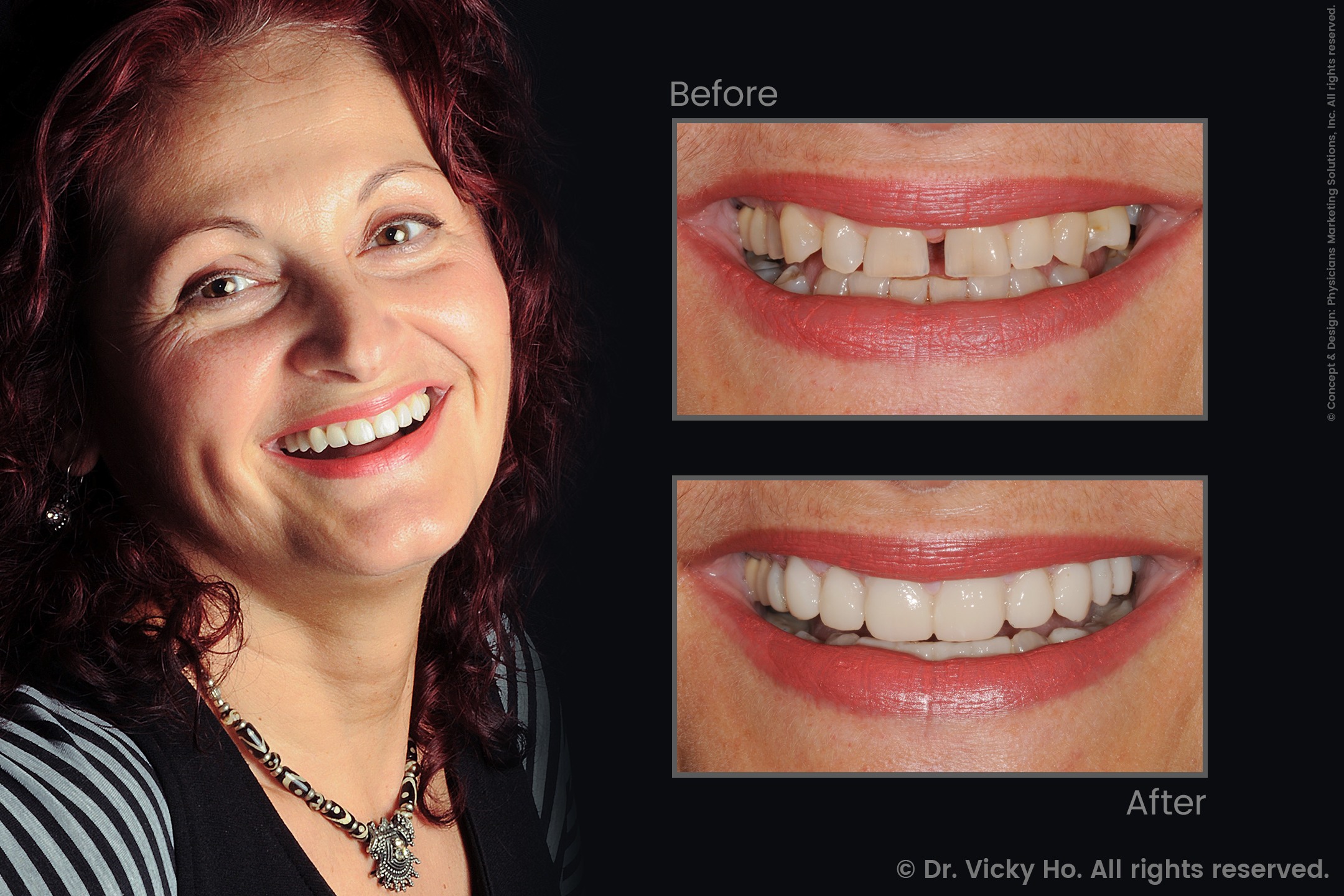 Laser Gum Lift with Porcelain Veneers and Dental Bridges