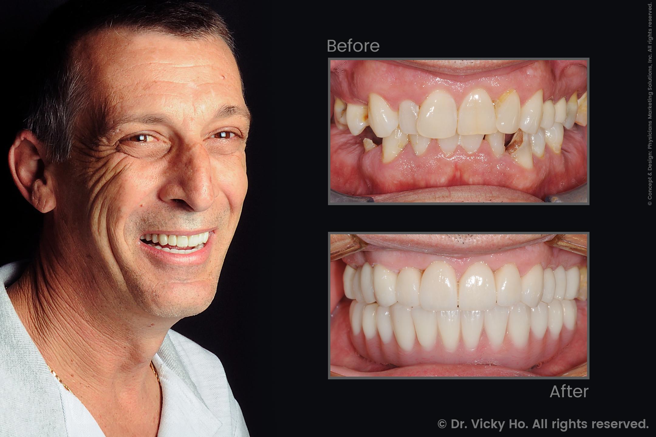 Laser Gum Lift, Crowns/Bridges, Veneers and Dental Implants