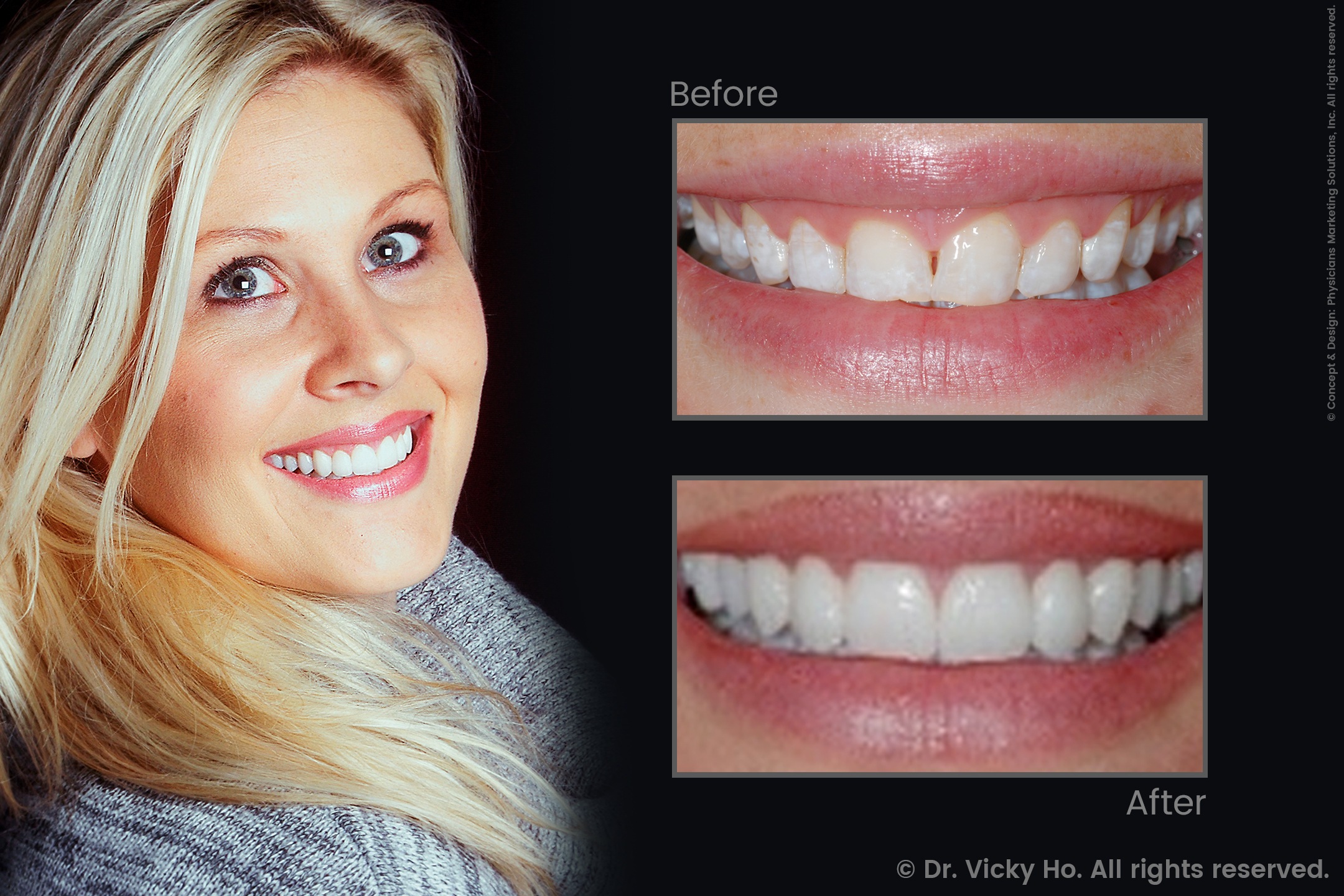 Laser Gum Lift, Veneers, Bridges and Whitening for Gummy Smile