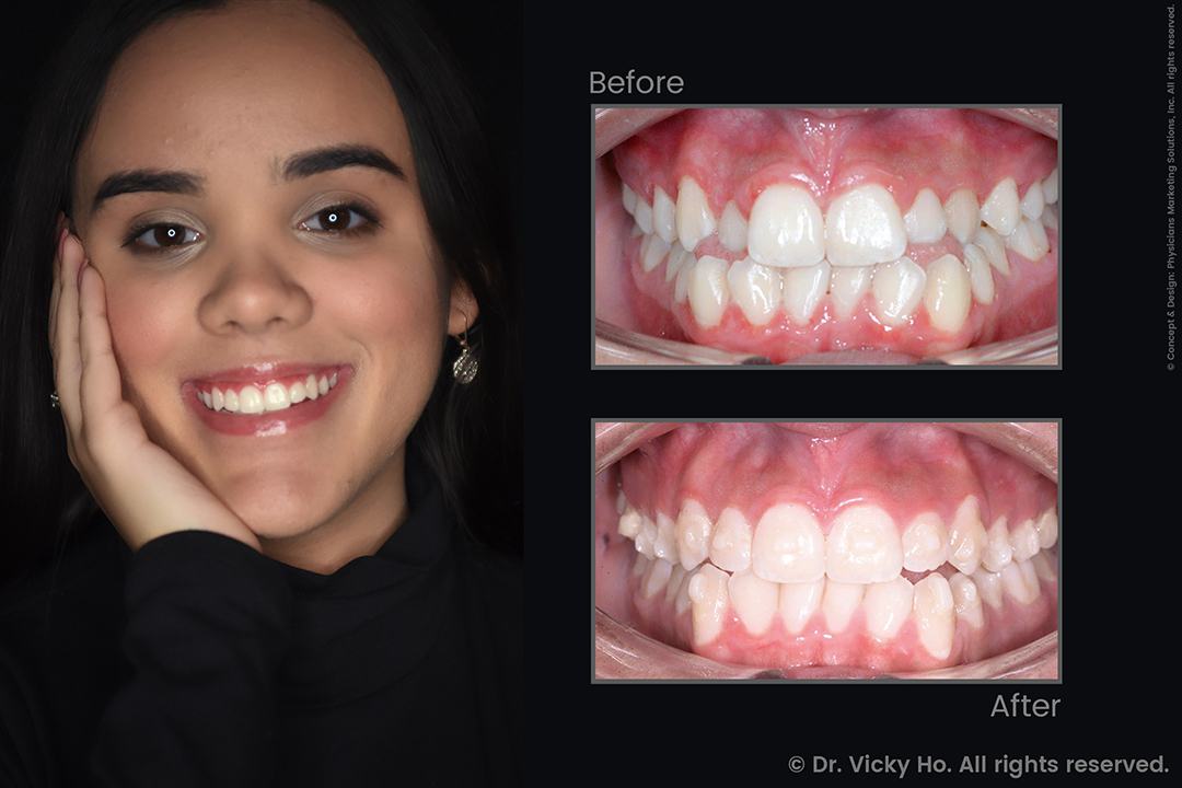 Invisalign Clear Aligners for Crowded, Crooked Teeth