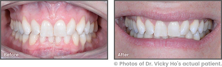 Before and After