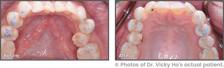 Before and After