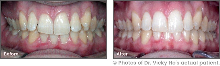 Before and After