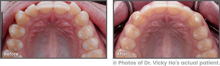 Before and After