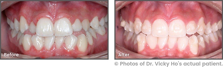 Before and After