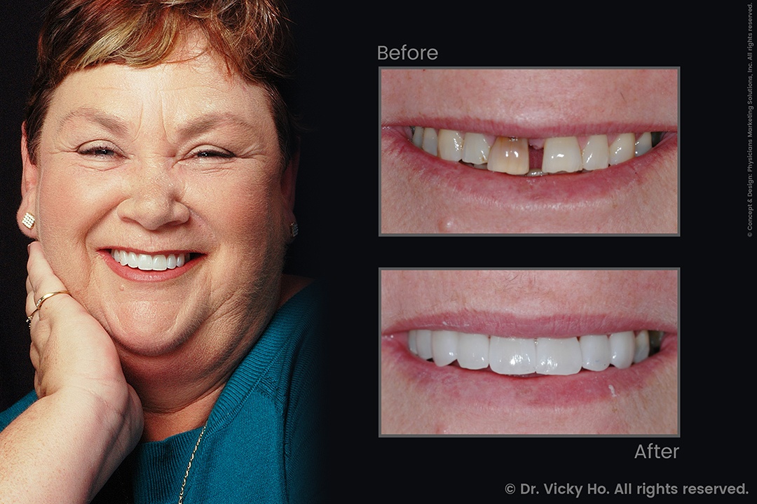 Laser Gum Lift, Crowns and Veneers for Gaps Between Front Teeth