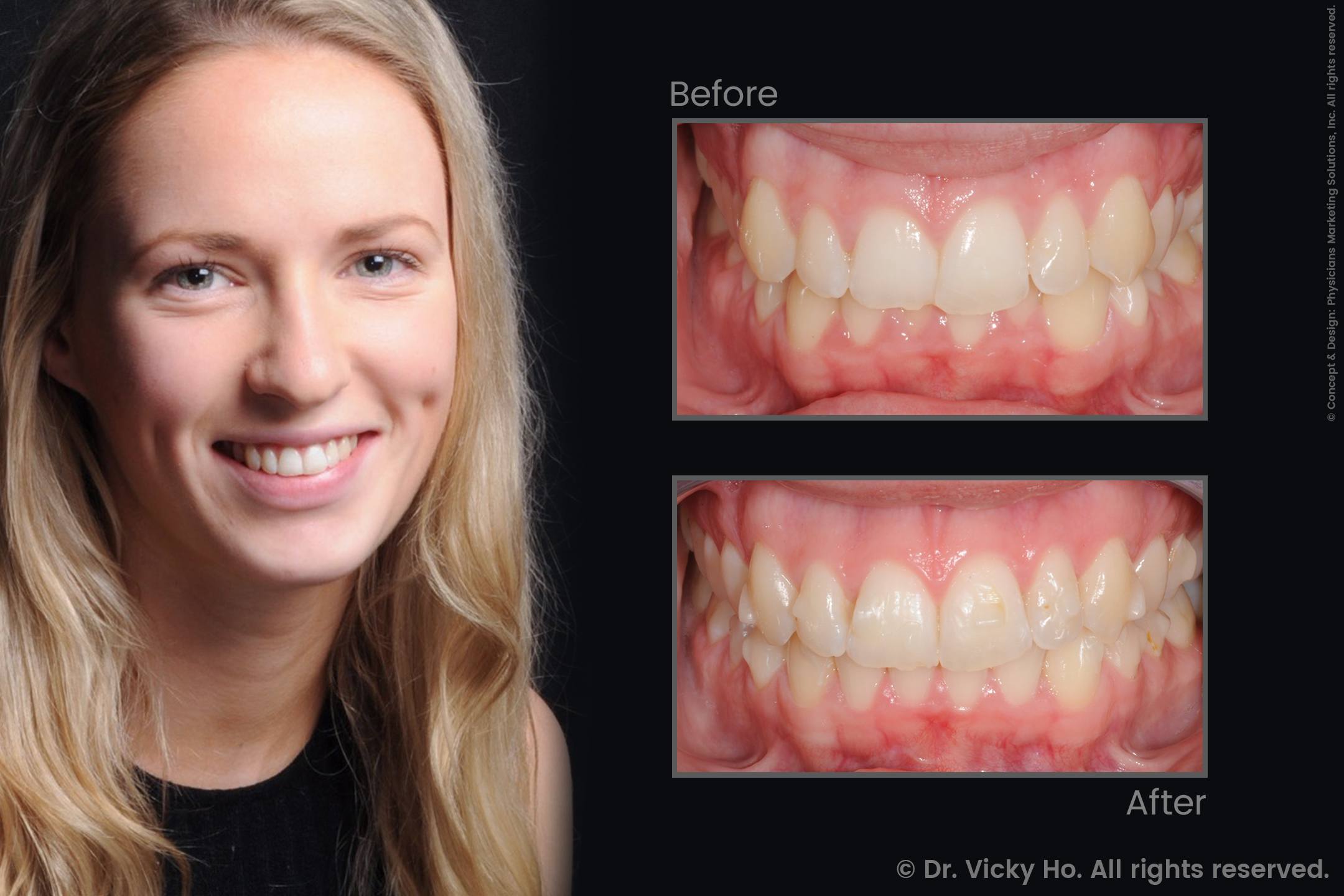 Invisalign Clear Aligners for Misaligned Teeth