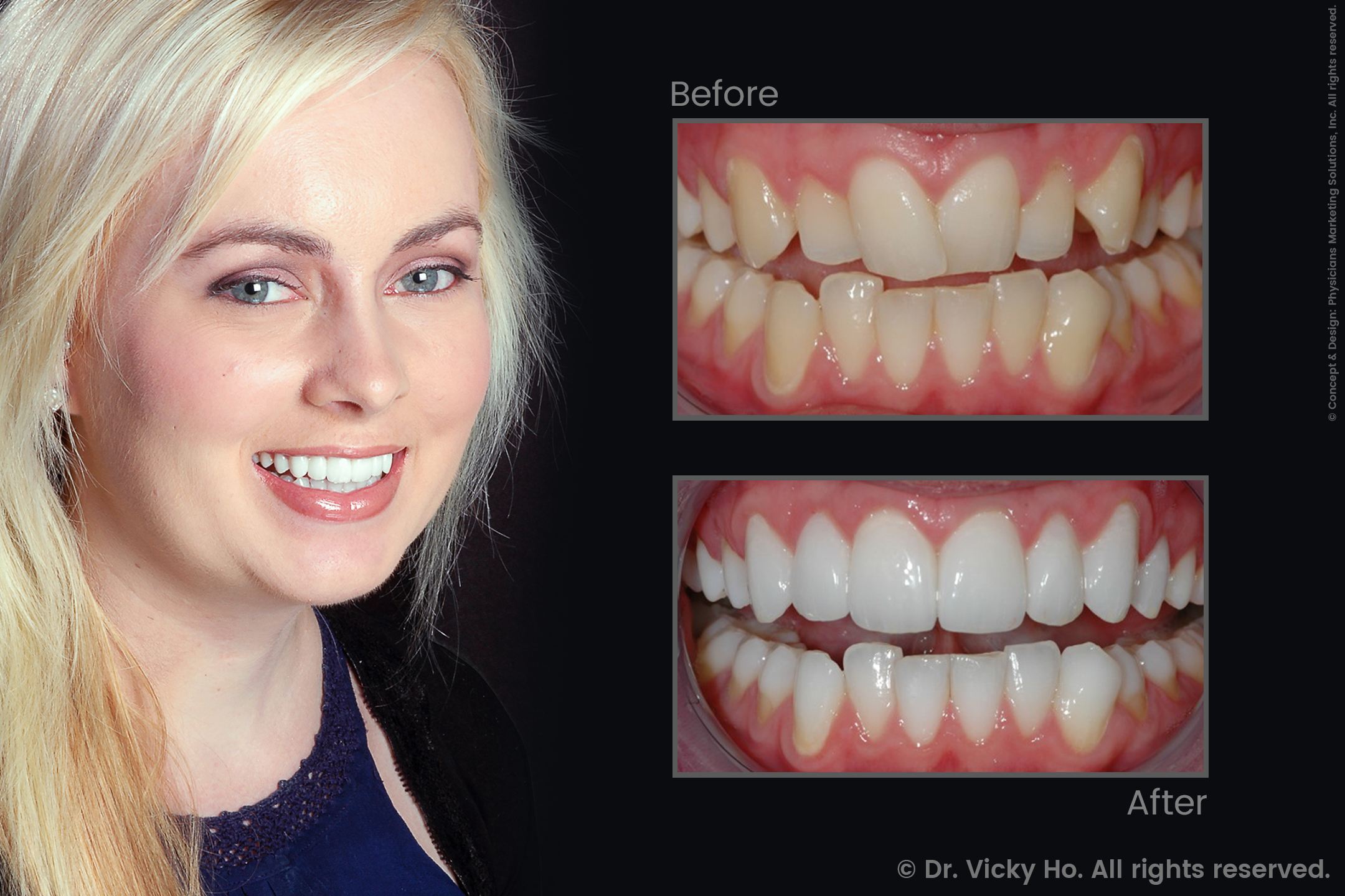 Laser Gum Lift, Veneers and Whitening for Crooked Teeth