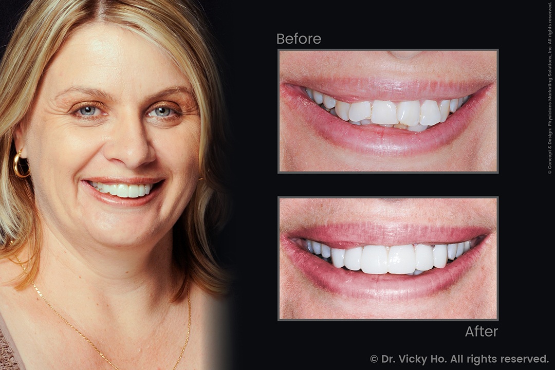Dental Veneers and Bridges for Misaligned, Discoloured Teeth