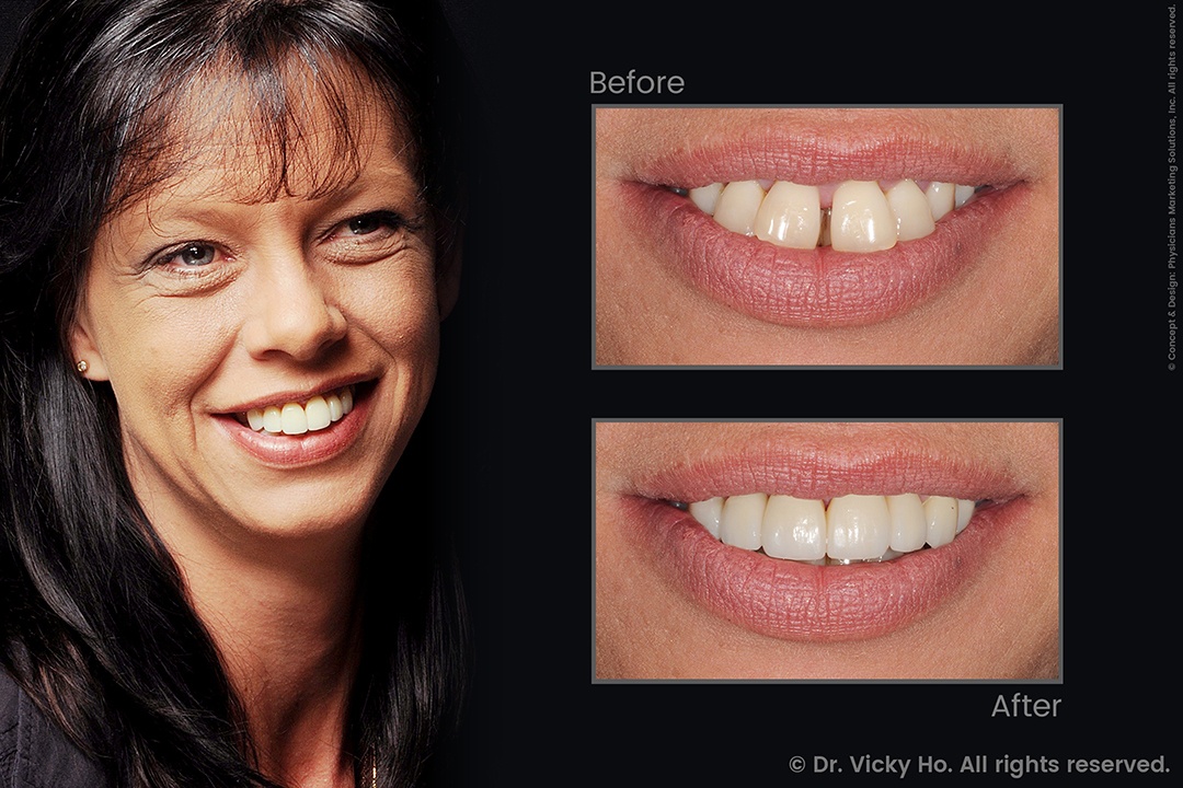 Veneers and Whitening for Bucked, Gapped Teeth