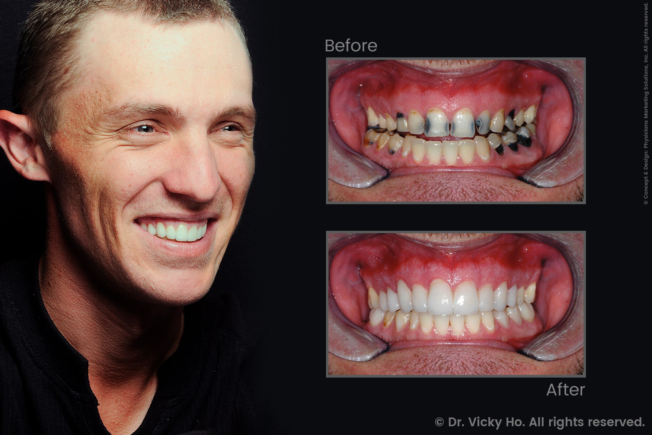 Laser Gum Lift, Crowns, Veneers and Whitening for Decayed Teeth