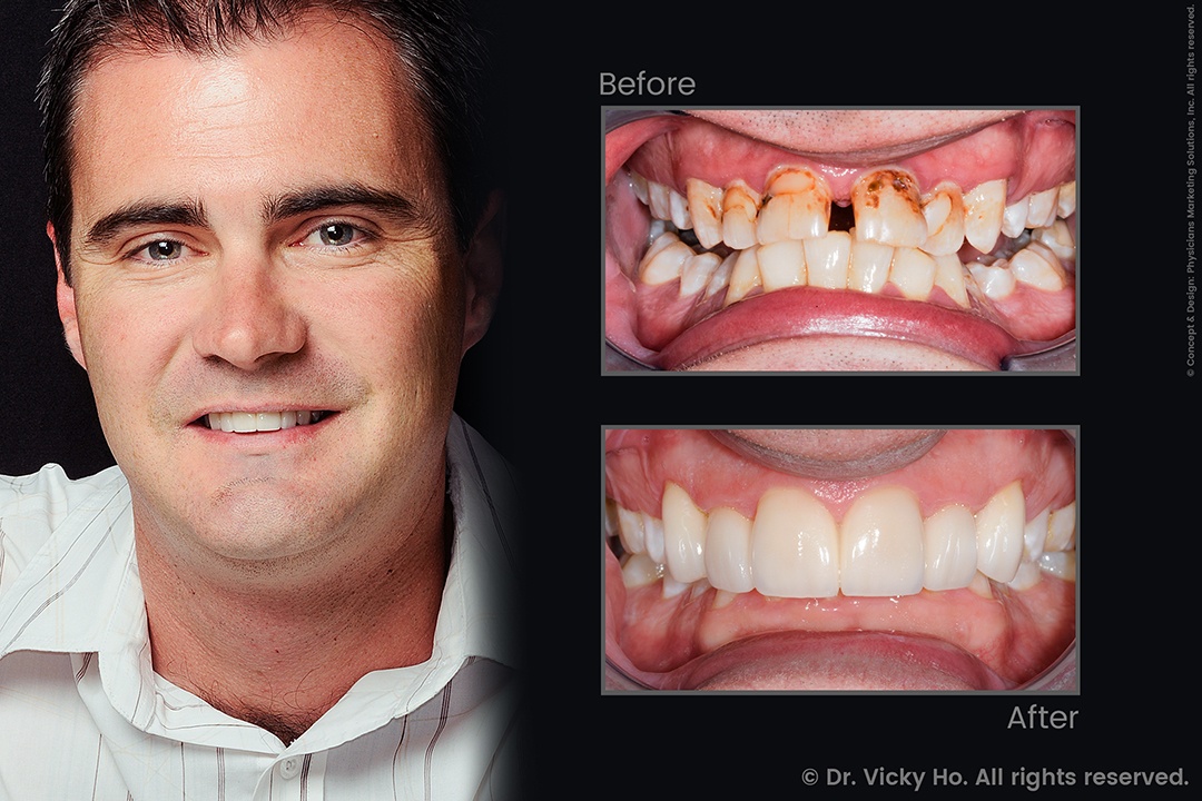 Laser Gum Lift, Veneers and Whitening for Broken, Gapped Teeth