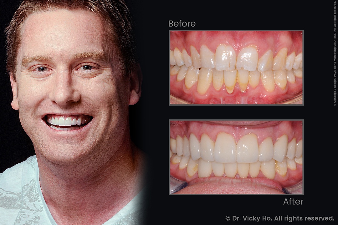 Laser Gum Lift and Veneers for Worn Teeth and Gummy Smile