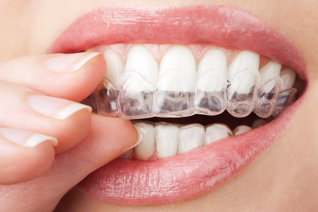 Invisalign 00